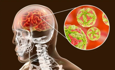 3 người tử vong vì viêm não virus, dấu hiệu nào cần lưu ý để tránh tai biến nặng?